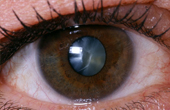 Заболевания глаз аллергического и инфекционного происхождения