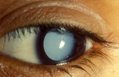 Причины возникновения катаракты и первые симптомы
