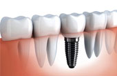 Этапы проведения имплантации зубов