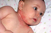 Аллергия у ребенка до года