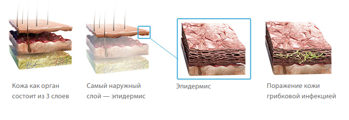 Как лечить грибок кожи