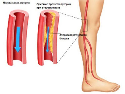 Причины болезни сосудов, их особенности и возможные заболевания