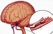 Диагностика и лечение атеросклероза сосудов головного мозга