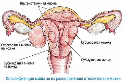 Виды заболеваний матки у женщин