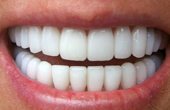 Отбеливание зубов: все За и Против