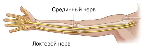 Почему повреждается срединный нерв и как его лечить?