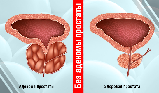 ДГПЖ и простатит