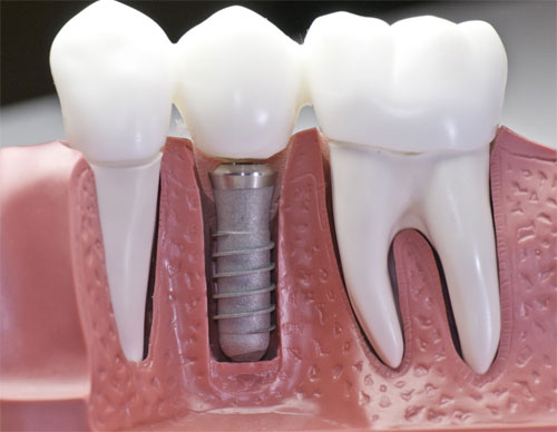 Долговечность и качество имплантации зубов