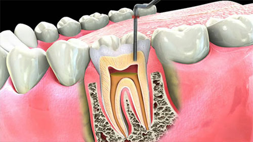 Зубные каналы