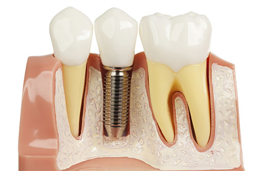 Зубные импланты: виды и характеристики