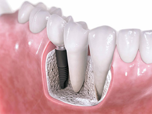 Как вставляют импланты зубов?
