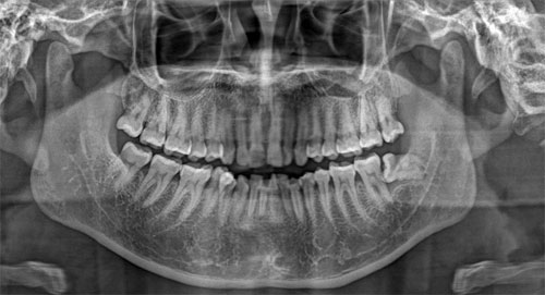 Панорамный снимок зубов