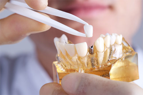 Виды протезирования в зависимости от состояния и количества своих зубов