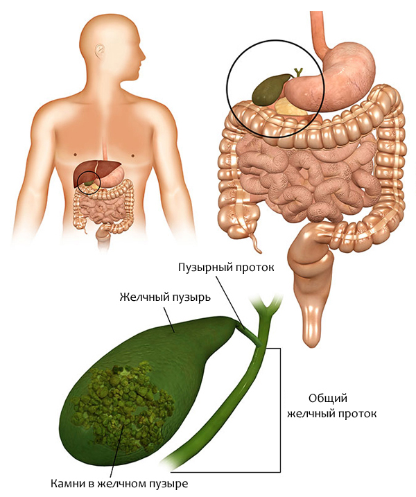 Какие симптомы имеет хронический холецистит?