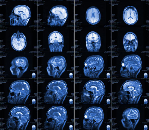 Каковы показания к проведению процедуры МРТ головного мозга