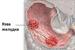 Язва желудка. Лечение народными средствами