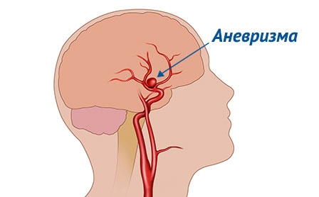 Аневризма сосудов мозга