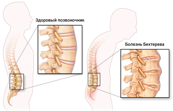 Симптомы и лечение болезни Бехтерева