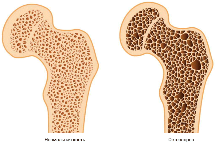 Как диагностируется остеопороз?