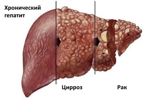 Рак печени