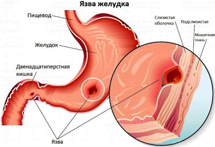 Язва желудкам