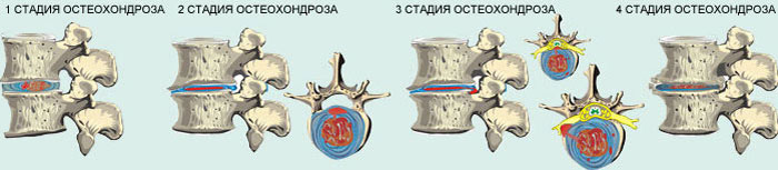 Остеохондроз