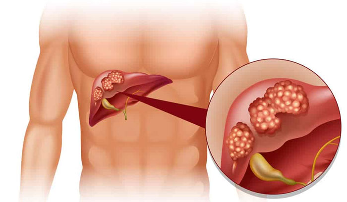 Киста печени: удалять нельзя лечить