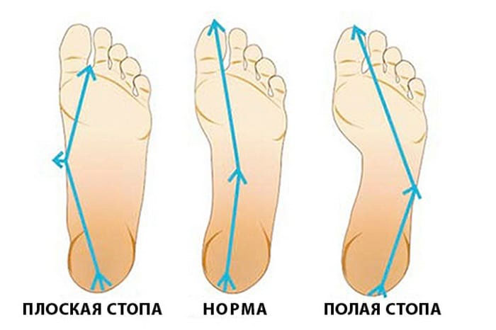 Продольное плоскостопие