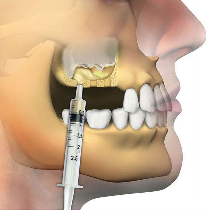 Решение проблемы с недостатком костной ткани зубов