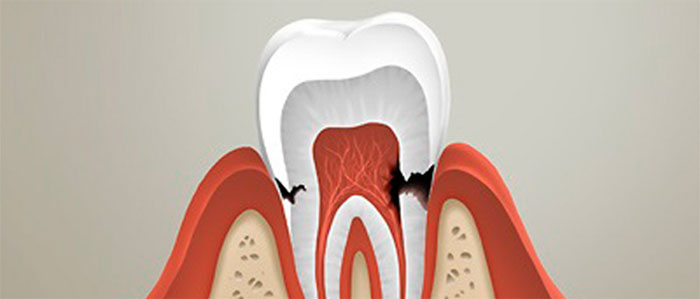 Кариес: специфика течения и причины возникновения