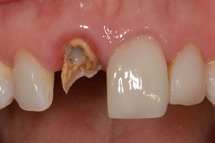 Показания к проведению имплантации зубов