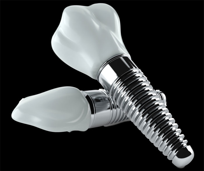 Основное назначение имплантации и протезирования зубов