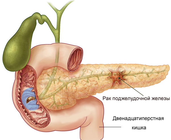 Рак поджелудочной железы