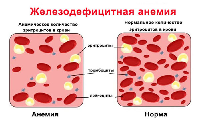 Железодефицитная анемия-лечение