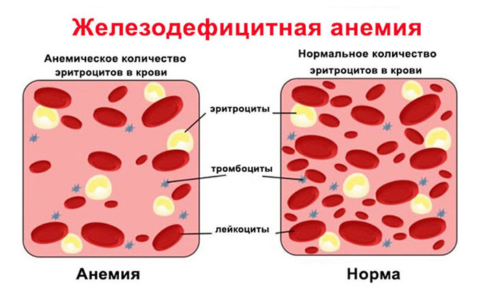 Железодефицитная анемия-лечение народной медициной