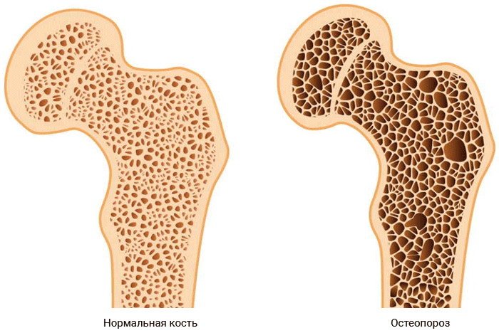 Остеопороз