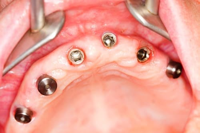 Зубные имплантаты All-on-6