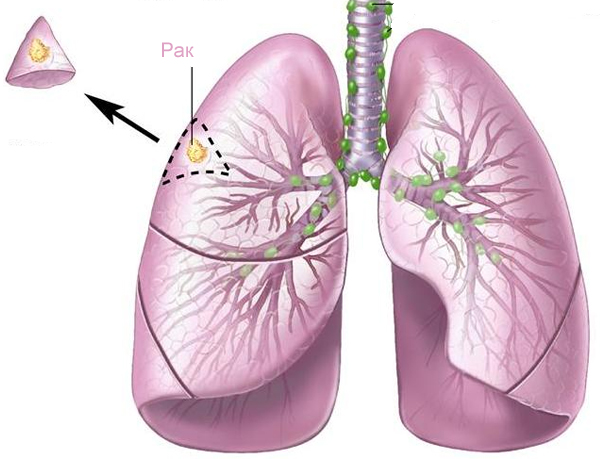 Как возникает рак легких