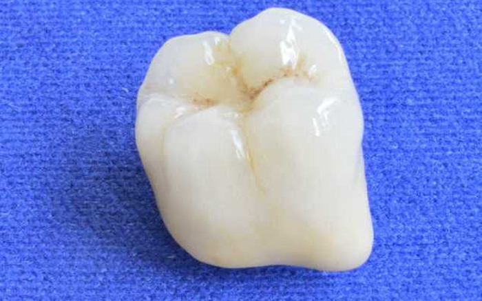 Протезирование зубов коронками