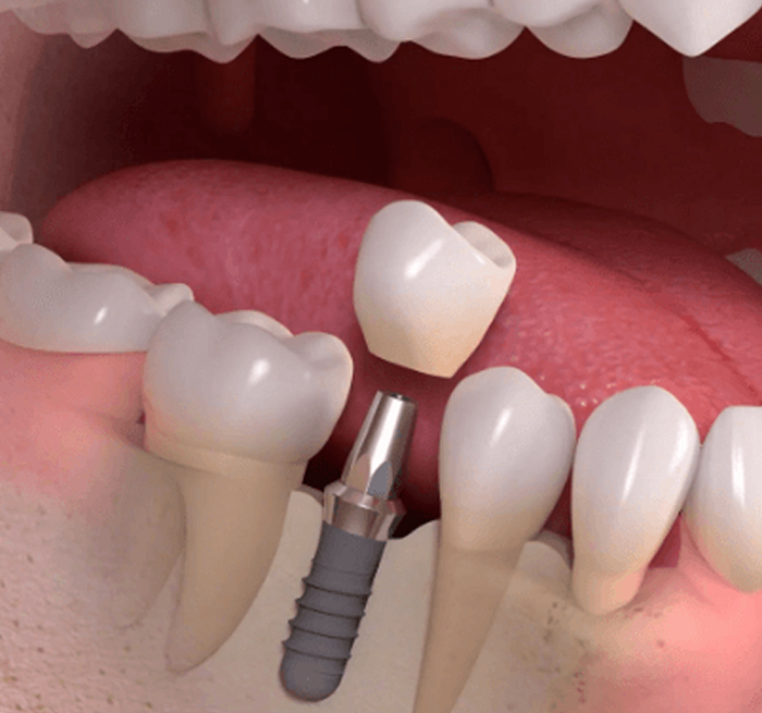 Имплантация зубов: специфика и преимущества