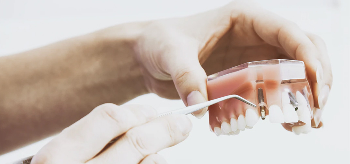 Имплантация зубов: специфика и преимущества