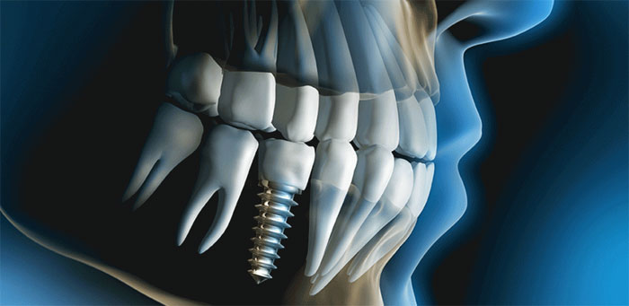 Современные виды имплантоллогии зубов