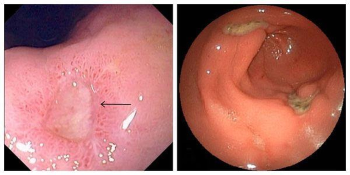 Язвенная болезнь желудка