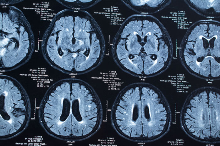 МРТ нормального здорового мозга