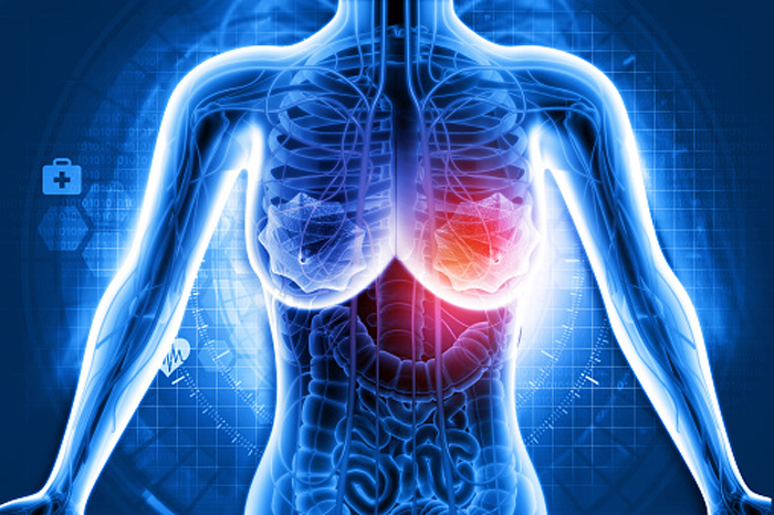 Почему рак груди распространяется на другие части тела