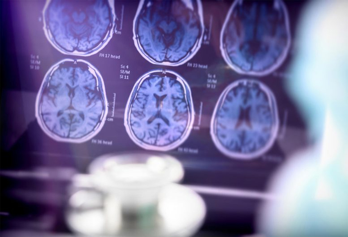 Белковое сканирование мозга при болезни Альцгеймера