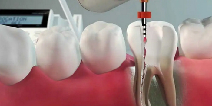 Как проходит реставрация зубов?