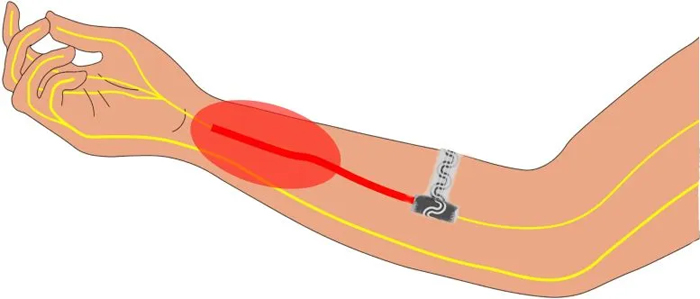 Иллюстрация имплантируемого устройства для снятия боли