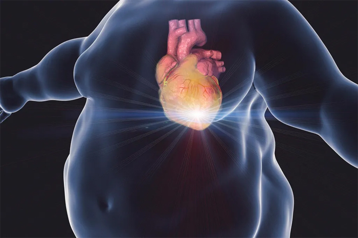 Иллюстрация сердечного приступа тучного человека