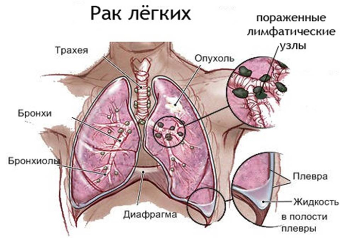 Карцинома легкого: причины, симптомы и методы лечения